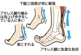 アキレス腱の痛みは指上げ歩きをしている人に多い