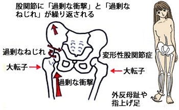 股関節の痛みの原因解説図