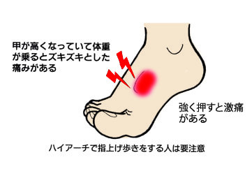足の甲の痛み